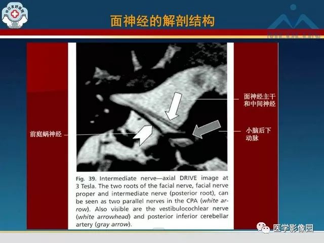 【PPT】面神经病变的影像