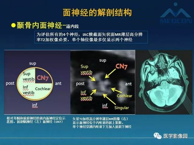 【PPT】面神经病变的影像