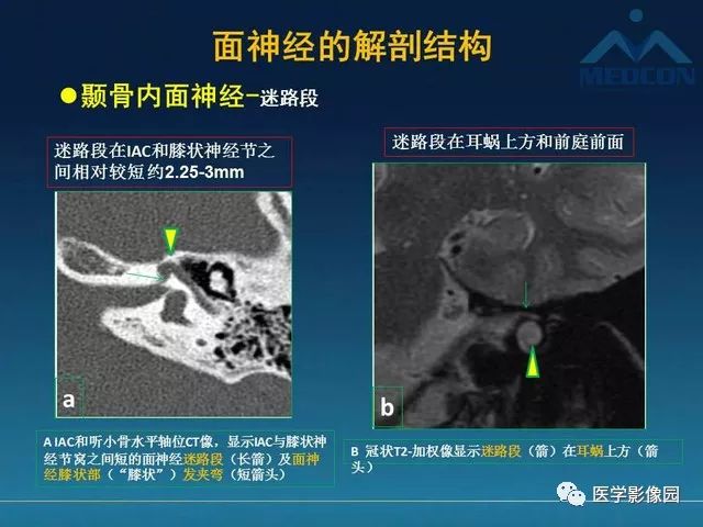 【PPT】面神经病变的影像
