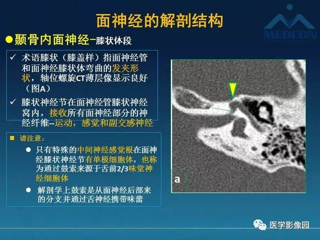 【PPT】面神经病变的影像