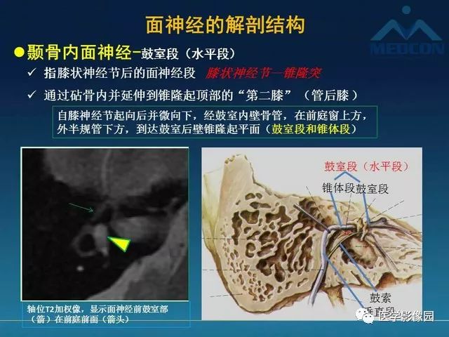【PPT】面神经病变的影像