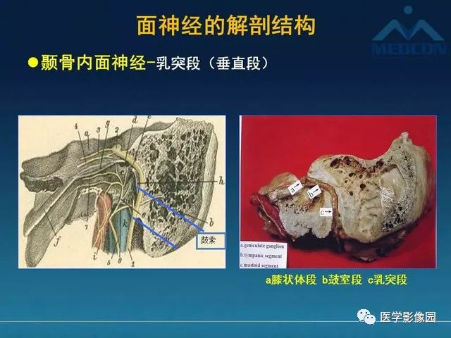 【PPT】面神经病变的影像