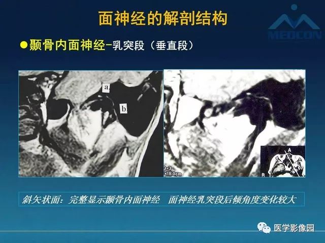 【PPT】面神经病变的影像