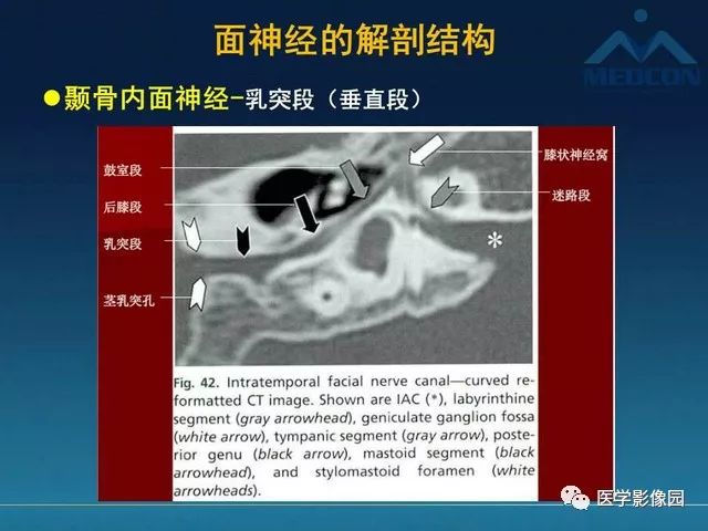 【PPT】面神经病变的影像