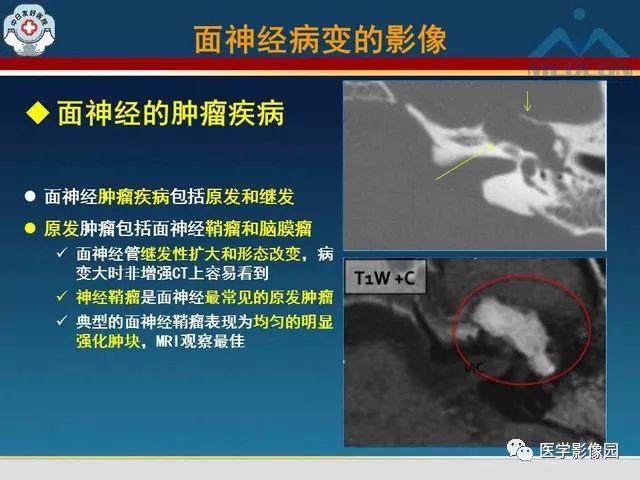 【PPT】面神经病变的影像