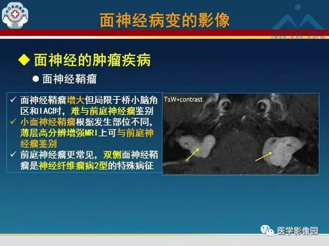 【PPT】面神经病变的影像