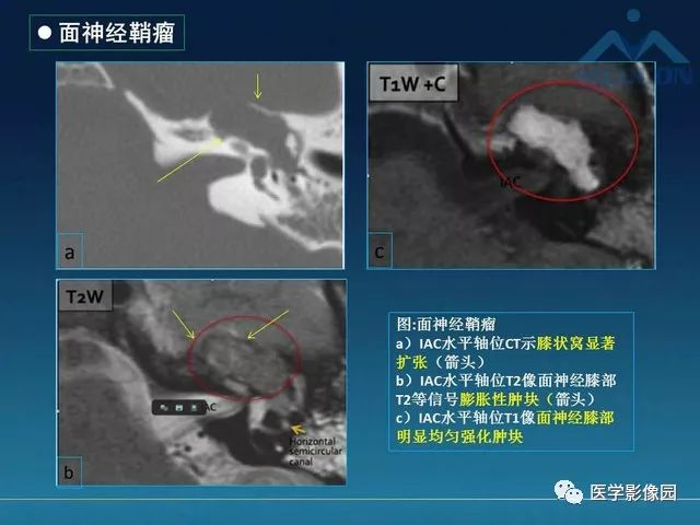 【PPT】面神经病变的影像
