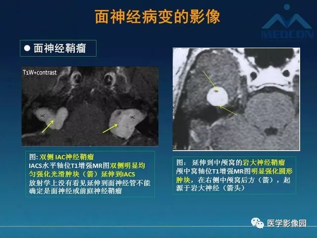 【PPT】面神经病变的影像