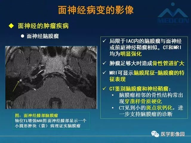 【PPT】面神经病变的影像