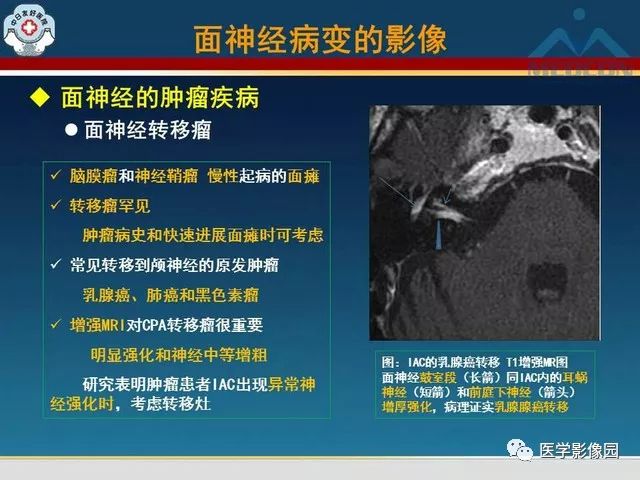 【PPT】面神经病变的影像