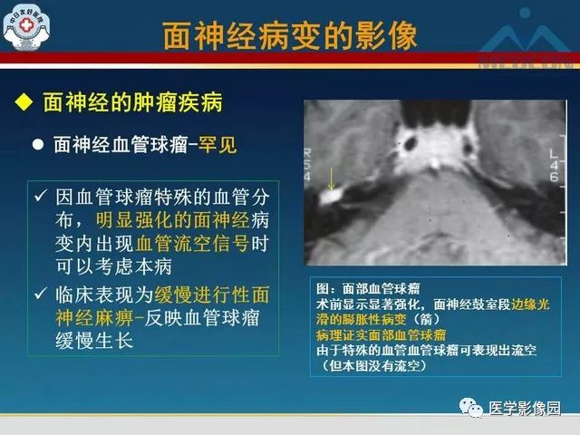 【PPT】面神经病变的影像
