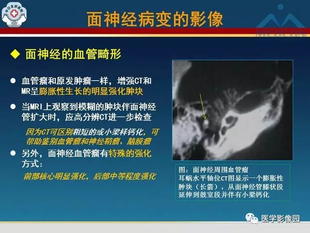 【PPT】面神经病变的影像