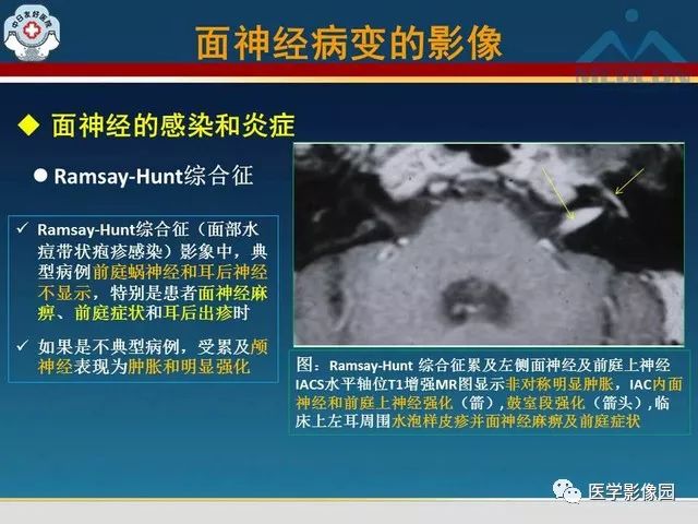【PPT】面神经病变的影像