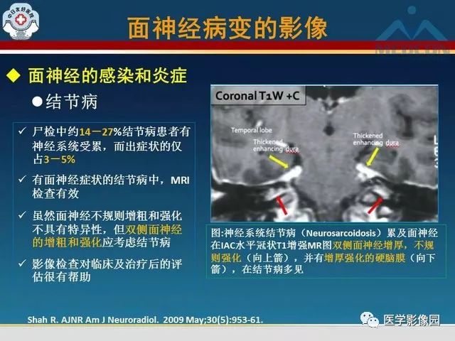 【PPT】面神经病变的影像