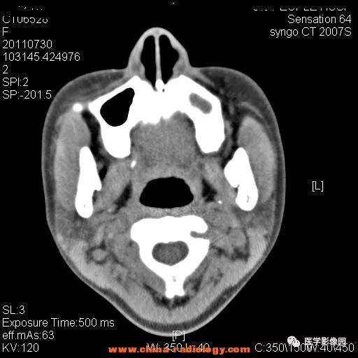 【病例】鼻窦横纹肌肉瘤1例CT影像表现 【病例】鼻窦横纹肌肉瘤1例CT影像表现
