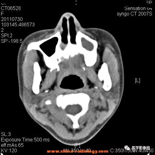【病例】鼻窦横纹肌肉瘤1例CT影像表现 【病例】鼻窦横纹肌肉瘤1例CT影像表现