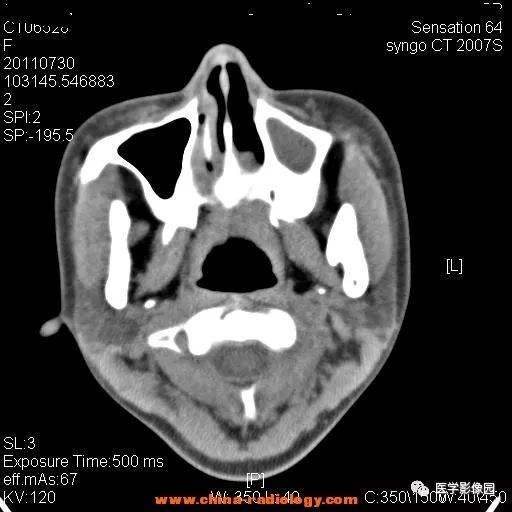【病例】鼻窦横纹肌肉瘤1例CT影像表现 【病例】鼻窦横纹肌肉瘤1例CT影像表现
