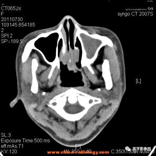 【病例】鼻窦横纹肌肉瘤1例CT影像表现 【病例】鼻窦横纹肌肉瘤1例CT影像表现
