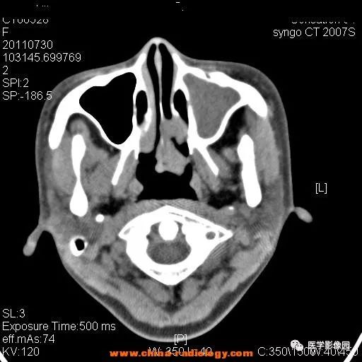 【病例】鼻窦横纹肌肉瘤1例CT影像表现 【病例】鼻窦横纹肌肉瘤1例CT影像表现