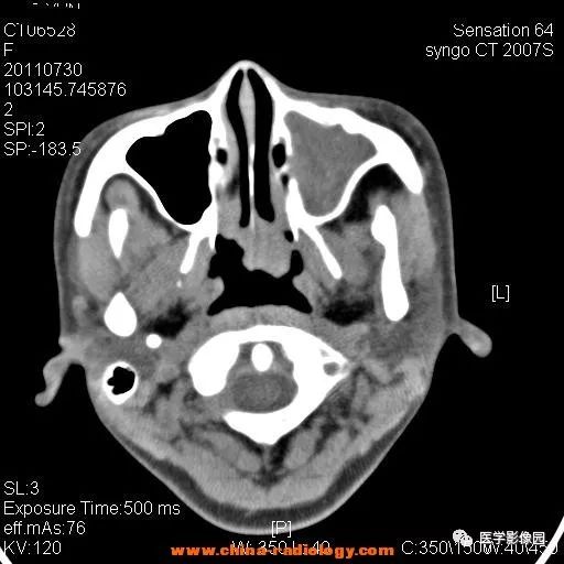 【病例】鼻窦横纹肌肉瘤1例CT影像表现 【病例】鼻窦横纹肌肉瘤1例CT影像表现