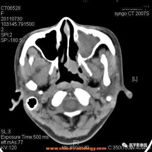 【病例】鼻窦横纹肌肉瘤1例CT影像表现 【病例】鼻窦横纹肌肉瘤1例CT影像表现