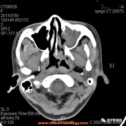【病例】鼻窦横纹肌肉瘤1例CT影像表现 【病例】鼻窦横纹肌肉瘤1例CT影像表现