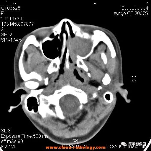 【病例】鼻窦横纹肌肉瘤1例CT影像表现 【病例】鼻窦横纹肌肉瘤1例CT影像表现