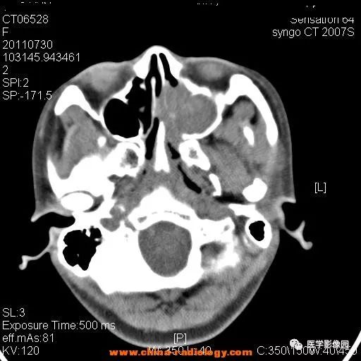 【病例】鼻窦横纹肌肉瘤1例CT影像表现 【病例】鼻窦横纹肌肉瘤1例CT影像表现
