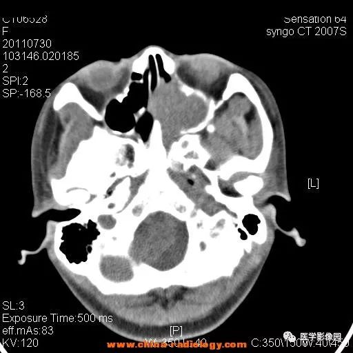 【病例】鼻窦横纹肌肉瘤1例CT影像表现 【病例】鼻窦横纹肌肉瘤1例CT影像表现