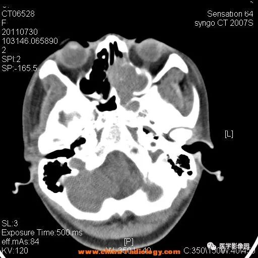 【病例】鼻窦横纹肌肉瘤1例CT影像表现 【病例】鼻窦横纹肌肉瘤1例CT影像表现
