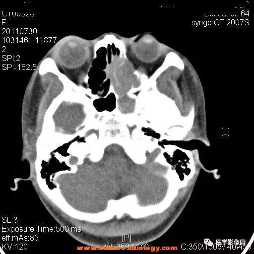 【病例】鼻窦横纹肌肉瘤1例CT影像表现 【病例】鼻窦横纹肌肉瘤1例CT影像表现