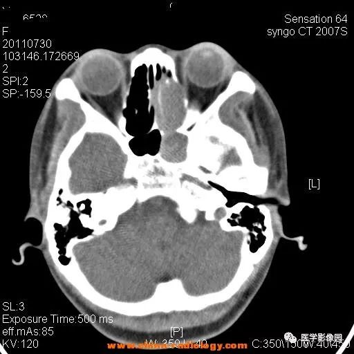 【病例】鼻窦横纹肌肉瘤1例CT影像表现 【病例】鼻窦横纹肌肉瘤1例CT影像表现