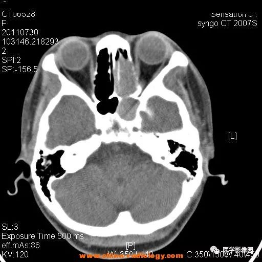 【病例】鼻窦横纹肌肉瘤1例CT影像表现 【病例】鼻窦横纹肌肉瘤1例CT影像表现