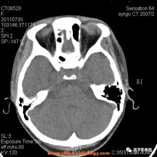 【病例】鼻窦横纹肌肉瘤1例CT影像表现 【病例】鼻窦横纹肌肉瘤1例CT影像表现