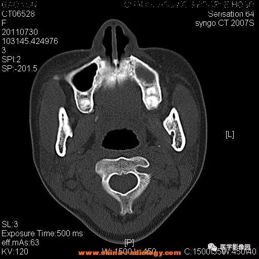 【病例】鼻窦横纹肌肉瘤1例CT影像表现 【病例】鼻窦横纹肌肉瘤1例CT影像表现