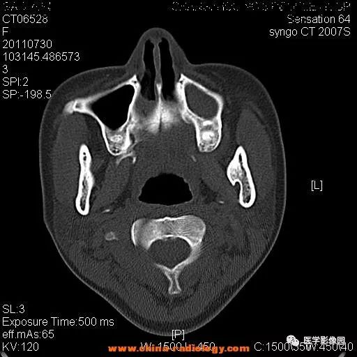 【病例】鼻窦横纹肌肉瘤1例CT影像表现 【病例】鼻窦横纹肌肉瘤1例CT影像表现