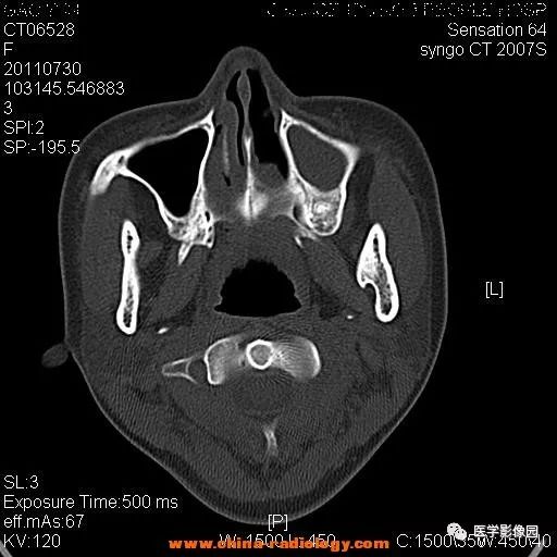 【病例】鼻窦横纹肌肉瘤1例CT影像表现 【病例】鼻窦横纹肌肉瘤1例CT影像表现