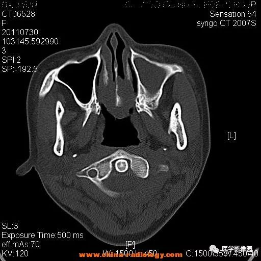 【病例】鼻窦横纹肌肉瘤1例CT影像表现 【病例】鼻窦横纹肌肉瘤1例CT影像表现