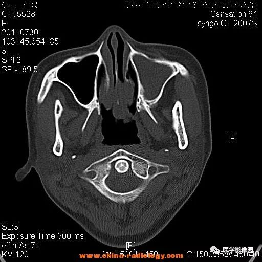 【病例】鼻窦横纹肌肉瘤1例CT影像表现 【病例】鼻窦横纹肌肉瘤1例CT影像表现