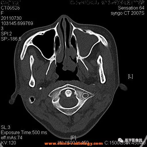 【病例】鼻窦横纹肌肉瘤1例CT影像表现 【病例】鼻窦横纹肌肉瘤1例CT影像表现