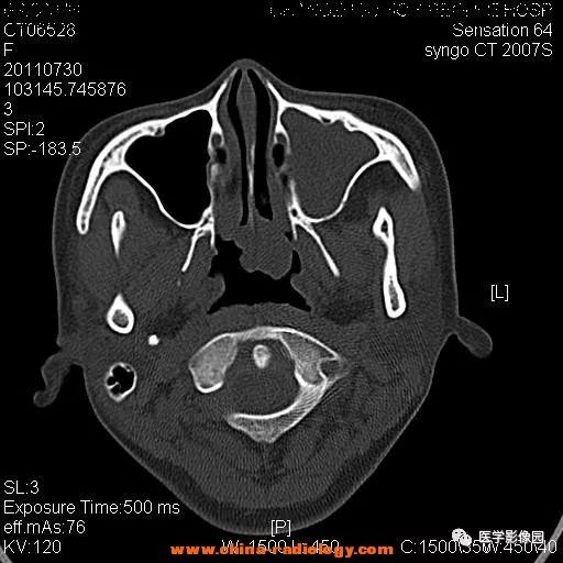 【病例】鼻窦横纹肌肉瘤1例CT影像表现 【病例】鼻窦横纹肌肉瘤1例CT影像表现