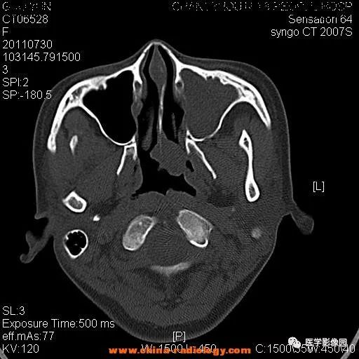 【病例】鼻窦横纹肌肉瘤1例CT影像表现 【病例】鼻窦横纹肌肉瘤1例CT影像表现