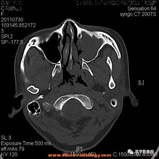 【病例】鼻窦横纹肌肉瘤1例CT影像表现 【病例】鼻窦横纹肌肉瘤1例CT影像表现