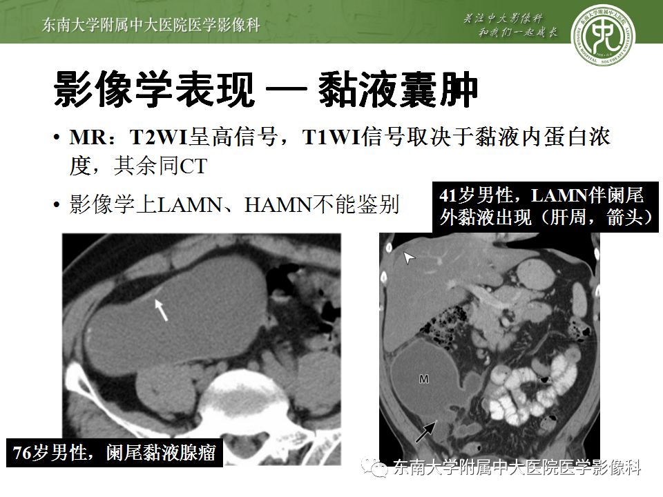 【病例】阑尾黏液性肿瘤1例CT影像表现