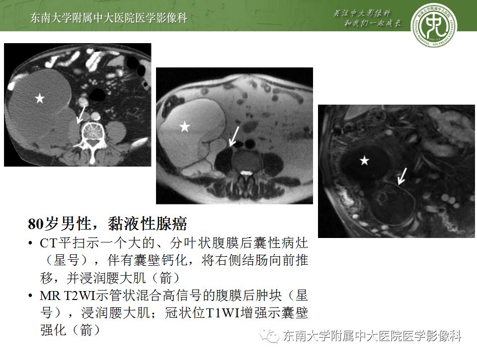 【病例】阑尾黏液性肿瘤1例CT影像表现