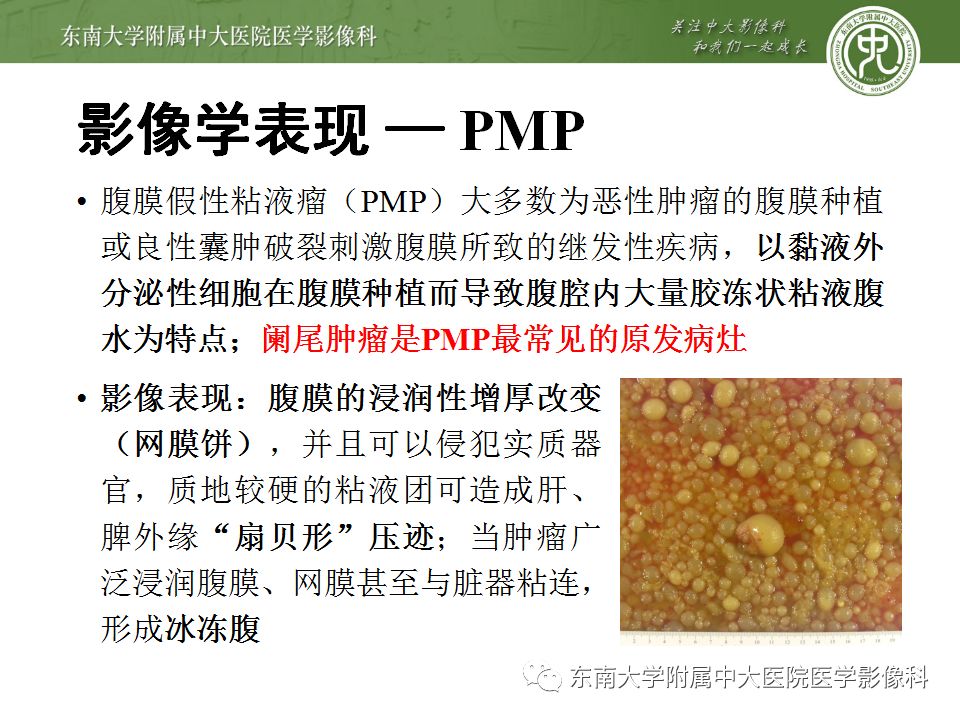 【病例】阑尾黏液性肿瘤1例CT影像表现