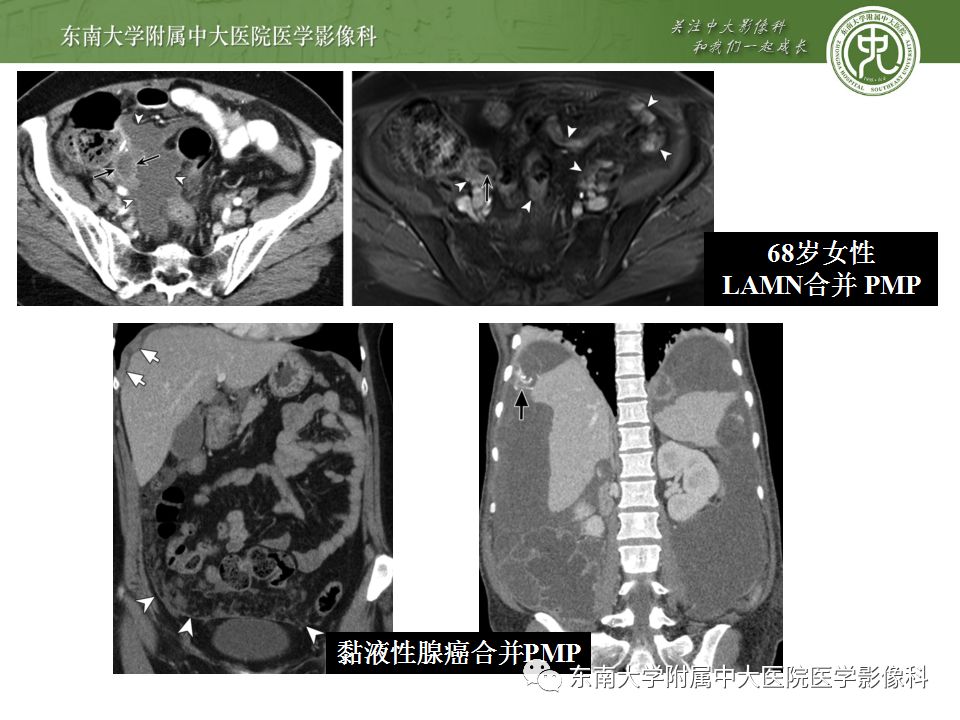 【病例】阑尾黏液性肿瘤1例CT影像表现