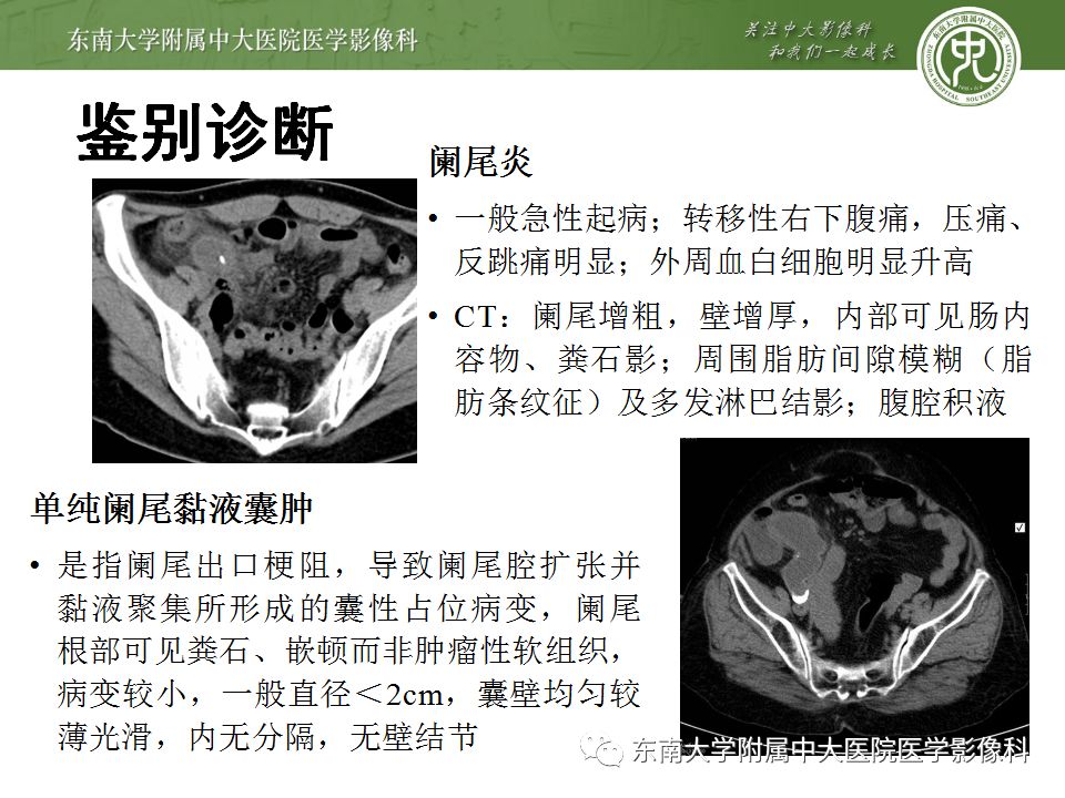 【病例】阑尾黏液性肿瘤1例CT影像表现