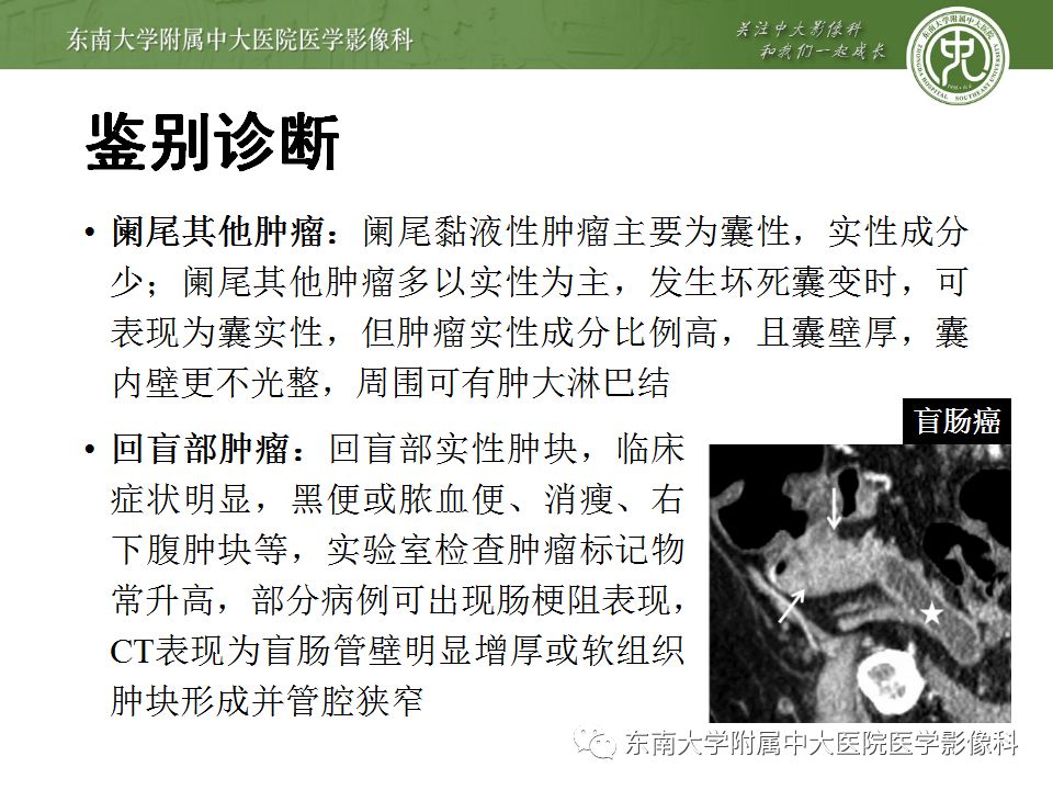 【病例】阑尾黏液性肿瘤1例CT影像表现