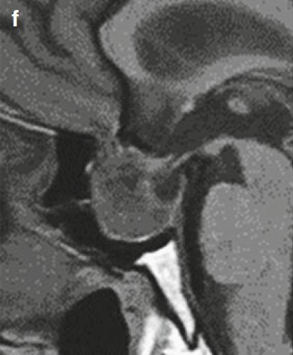 出血性垂体腺瘤 出血性垂体腺瘤